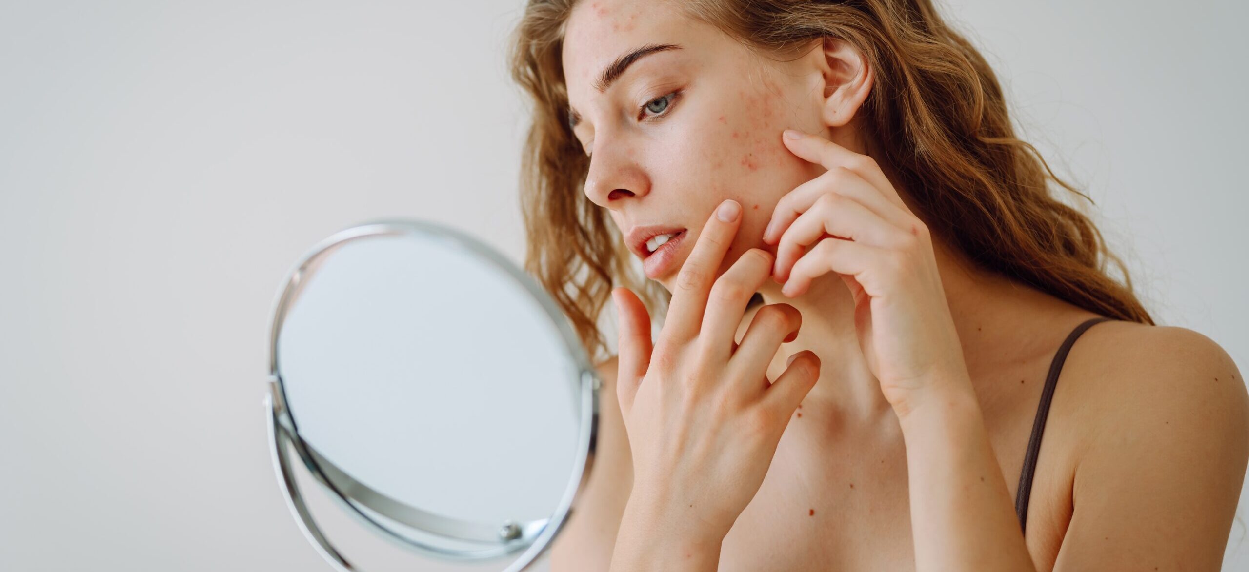 Rid of Acne